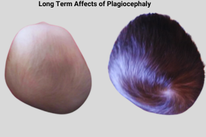 long term affects of plagiocephaly