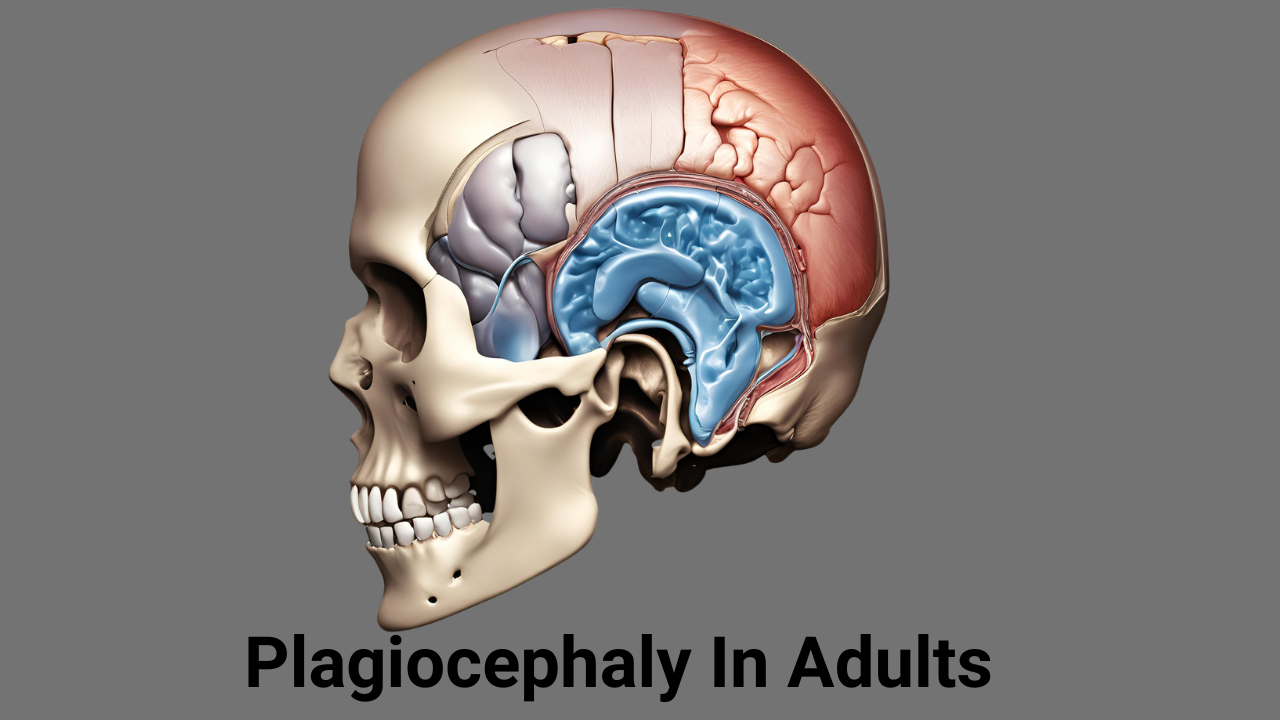 Plagiocephaly In Adults